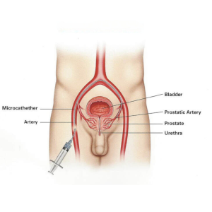 Diagram of Prostate Artery Embolization